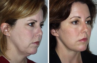 Face lift and Brow Lift