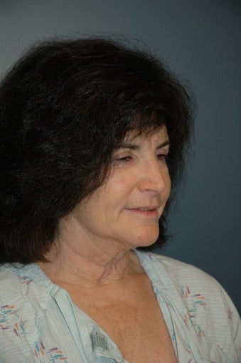 Cheek and Neck Lift