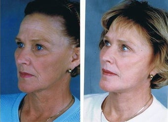 Facelift, Neck lift, Superficial cheek lift, CO2 laser resurfacing 