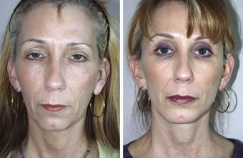 Facelift and Chin Implant