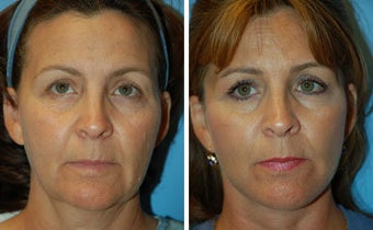 Facelift