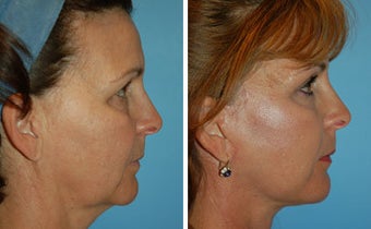 Facelift