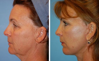Facelift