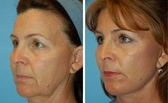Facelift