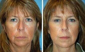 Facelift