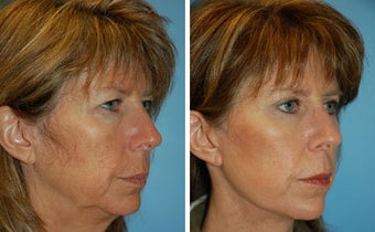 Facelift