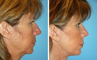 Facelift