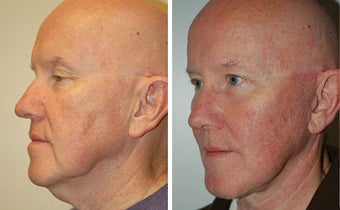 Facelift