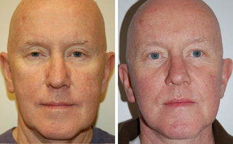 Facelift