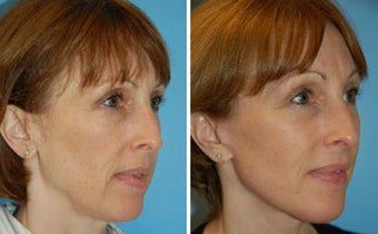 Facelift