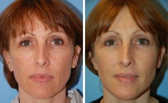 Facelift