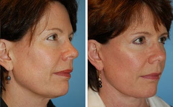 Facelift