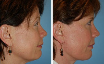 Facelift
