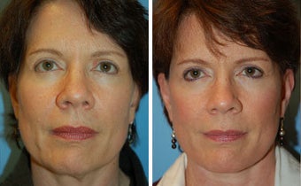 Facelift