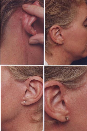 The no scar facelift incision