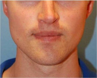 Jaw Implants for Jaw Augmentation