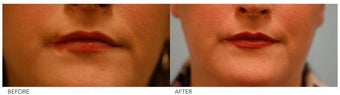 Lip Reduction/Lip Correction