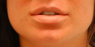 Corrective Lip Reduction