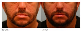 Lip Reduction/Lip Correction