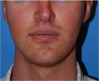 Jaw Implants for Jaw Augmentation