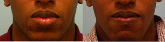 Lip Reduction/Lip Correction