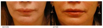 Lip Reduction/Lip Correction