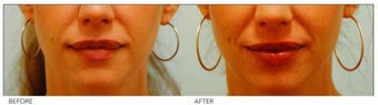 Lip Reduction/Lip Correction