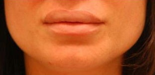 Corrective Lip Reduction