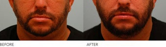 Lip Reduction/Lip Correction