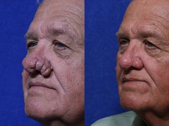 Rhinophyma removal