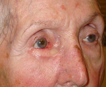 Eyelid cancer reconstruction