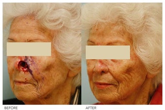 Facial Reconstruction