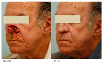 Facial Reconstruction