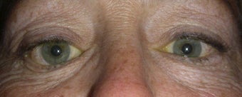 Orbital Decompression with Fat and Bone Removal