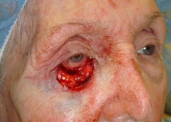 Eyelid cancer reconstruction