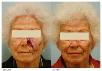 Facial Reconstruction