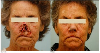 Facial Reconstruction