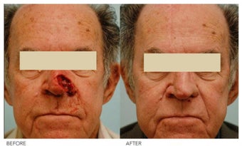 Facial Reconstruction