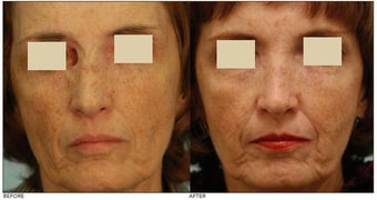 Facial Reconstruction