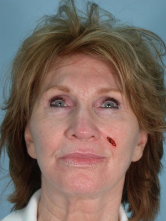 Facial Reconstruction
