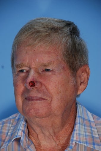 Facial Reconstruction