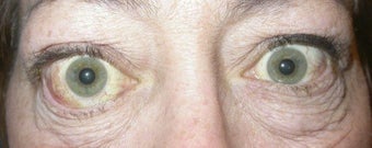 Orbital Decompression with Fat and Bone Removal