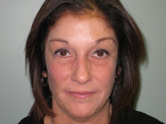 Quadbleph "eyelid lift" with midface lift, botox and juvederm to forehead
