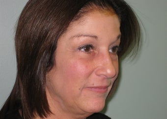 quadbleph "eyelid lift" with midface lift, botox and juvederm to forehead