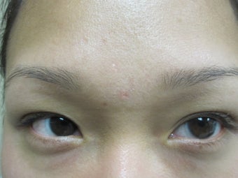 Sebaceous Hyperplasia Before & After Treatments