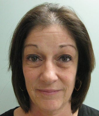 Quadbleph "eyelid lift" with midface lift, botox and juvederm to forehead