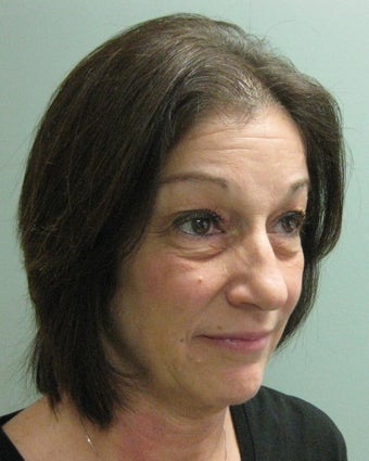 quadbleph "eyelid lift" with midface lift, botox and juvederm to forehead