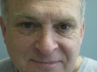 extended lower lid blepharoplasty