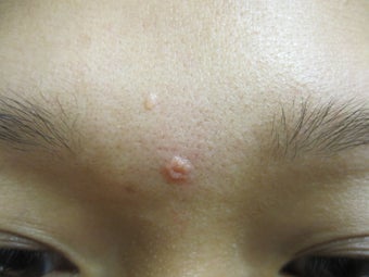 Sebaceous Hyperplasia Before & After Treatments