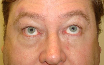 Orbital fracture repair